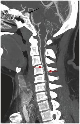 Case report: Delayed quadriplegia from traumatic carotid cavernous fistula: a rare case with perimedullary venous drainage